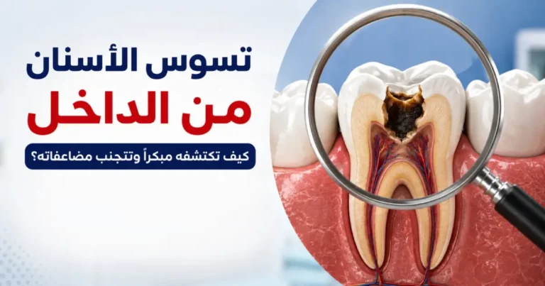 تسوس الاسنان من الداخل: كيف تكتشفه مبكراً وتتجنب مضاعفاته؟